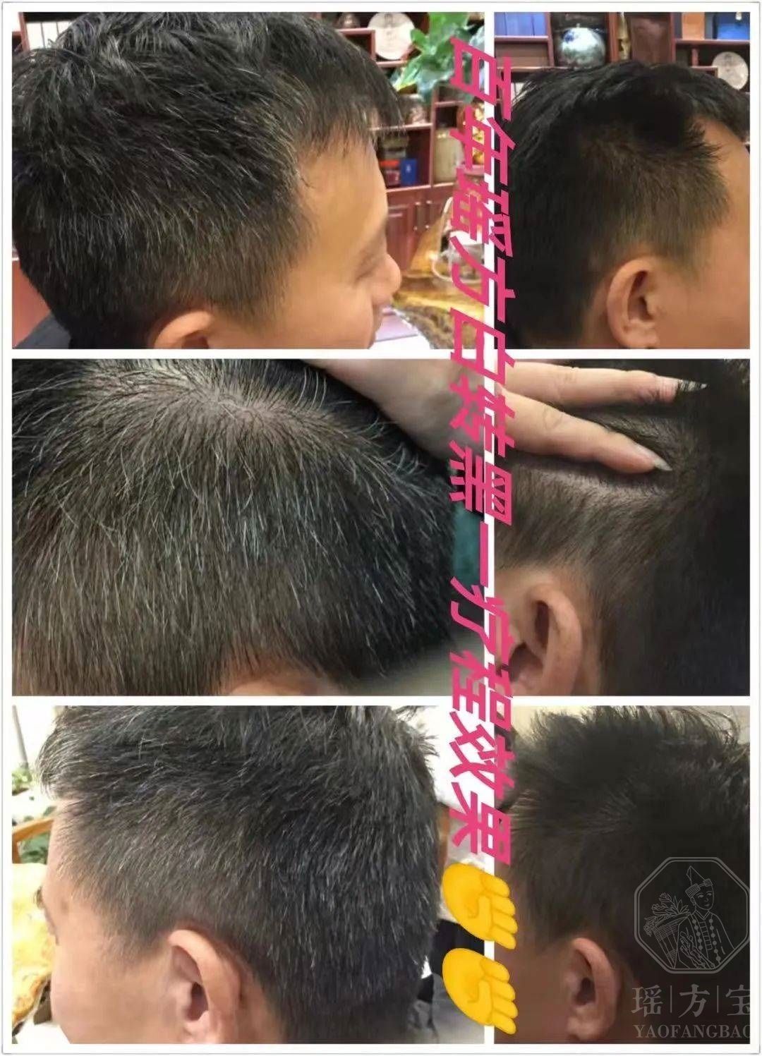 见证者 | 侯宇：瑶方神奇！我的白发真的转黑了！